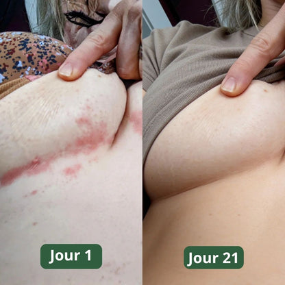 Savon anti-mycoses Puryvea - Fini les démangeaisons aux seins