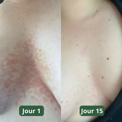 Savon anti-mycoses Puryvea - Fini les démangeaisons aux seins