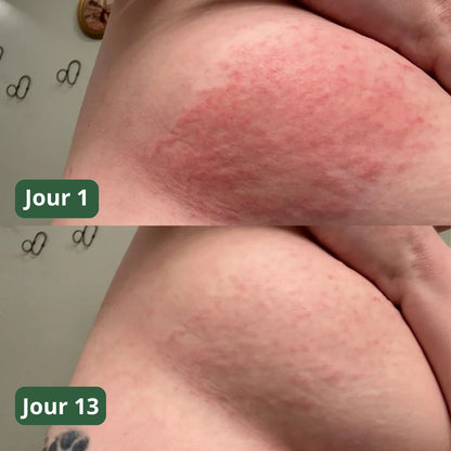 Savon anti-mycoses Puryvea - Fini les démangeaisons aux seins