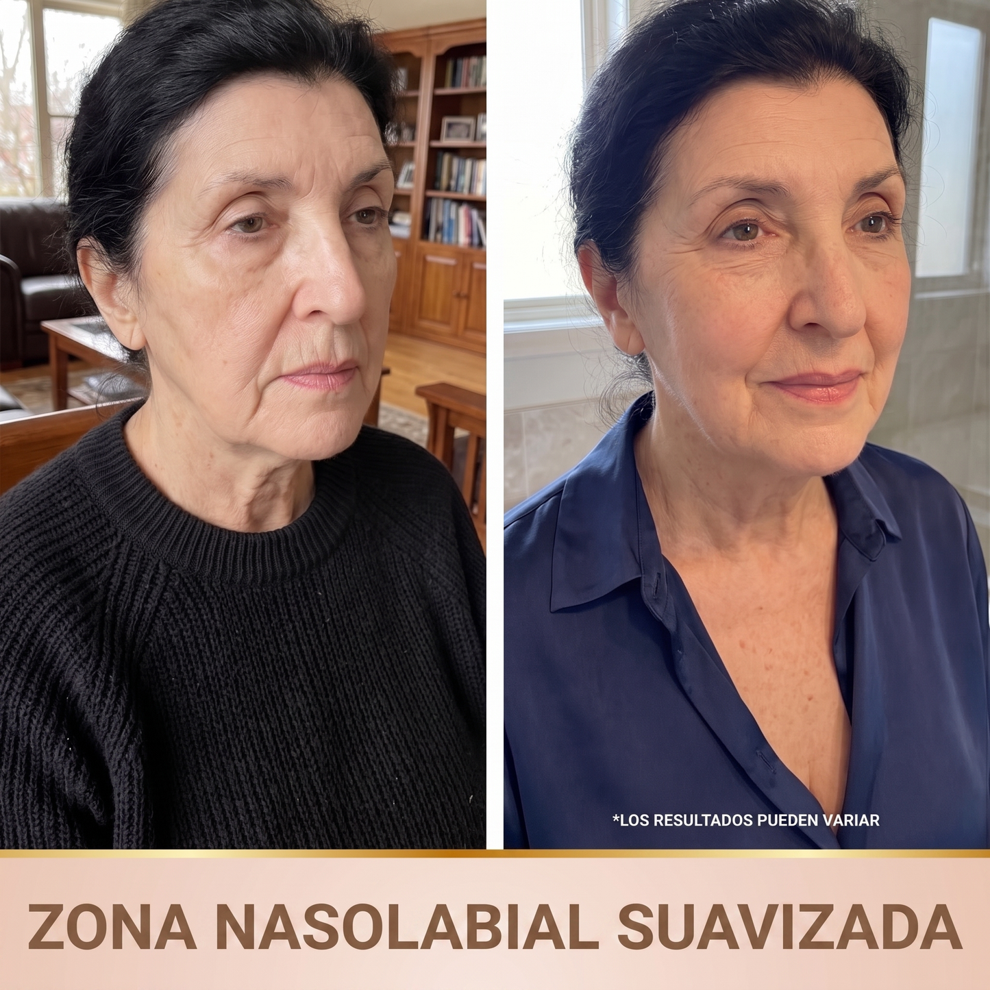 Orvane — Zona nasolabial suavizada
